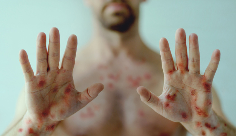 Sífilis en Argentina alcanzó récord histórico en 2025 con foco en Buenos Aires